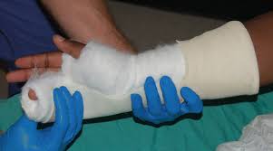 Image result for Ulnar Gutter Splint