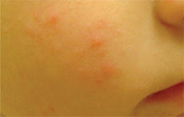 Image result for Papular Acrodermatitis