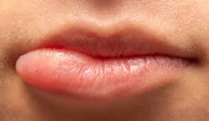 Bei der frage, was gegen geschwollene lippen hilft, sollten sie die ursachenforschung voranstellen. Geschwollene Unterlippe Ursachen Behandlung Vorbeugung Gesundpedia De