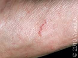 Image result for scabies human bites