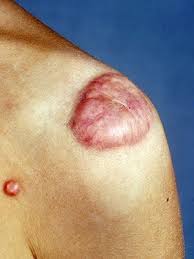 Some people only have one or two warts. What Is That Skin Growth Skin And Beauty Center Everyday Health