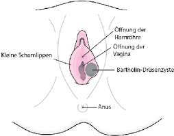 In manchen fällen finden sich bei einer pilzinfektion zusätzlich weißliche beläge an den schamlippen und der vagina. Bartholin Zysten Gesundheitsprobleme Von Frauen Msd Manual Ausgabe Fur Patienten