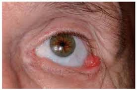 We did not find results for: Vascular Tumors And Related Lesions Of The Conjunctiva Ento Key