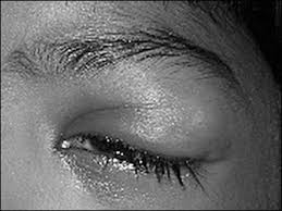 Image result for Dacryoadenitis