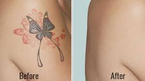 How To Remove Tattoos At Home Fast 28 Natural Ways At Home Tattoo Removal Tattoo Removal Cream Tattoo Removal Cost