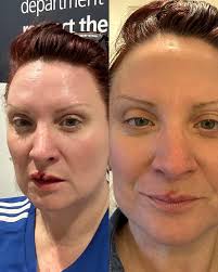 It wasn't the nicest morning of my life but the stitches are out and I  think it looks pretty bloody good. 💋 Quite incredible work and healing in  just 9 days, I