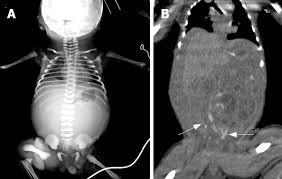 Image result for Midgut Volvulus