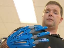 Teens use 3D printer to give amputee a helping hand