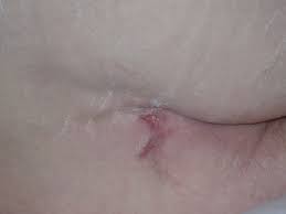 Image result for Skin Ulcer