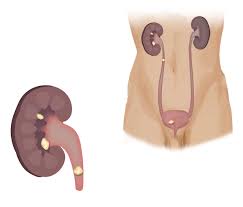 Kidney stones may be small and pass unnoticed through the urinary tract, but some grow to the size of a golf ball. Kidney Stones Gaytri Manek Formerly Gandotra Md