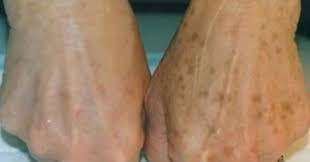 Reinige Deinen Dickdarm Nehme Bis Zu 9 Kilo Ab Und Entgifte Deinen Korper Mit Diesem Getrank Njuskam Hautflecken Altersflecken Braune Flecken Auf Der Haut