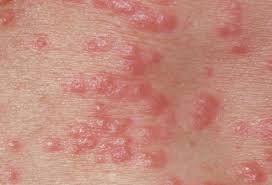 Bites And Infestations Pictures Of Bug Bites Stings Allergies And Infections