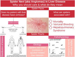 Fatty liver of moderate to severe degree. Nevus Araneus Aka Spider Angioma Spidernevi Angioma Grepmed