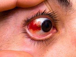 Red eyes are also referred to as bloodshot eyes, pink eye, and allergy eyes. Red Eyes List Of Common Causes