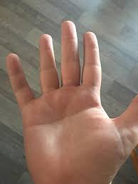 Maybe you would like to learn more about one of these? I Have A Single Transverse Palmar Crease Which Is A Single Crease That Extends Across The Palm Of Your Hand Which Is Found In People With Down Syndrome Only 1 5 Of People