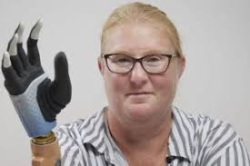 Mão biônica se funde com ossos, nervos e músculos de mulher sueca