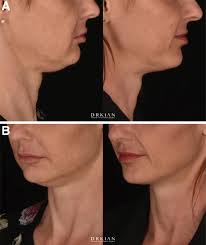 Transcutaneous Radiofrequency Microneedling in the Facial Plastic Surgeon's  Practice: A Review