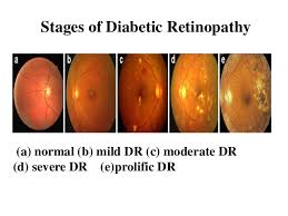 Receiving the treatment from the early stages will be helpful in preventing excessive damage to the. Diabetic Retinopathy Analysis Using Fundus Image