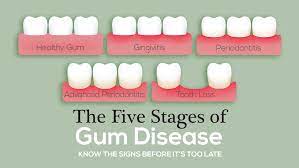 How can gum disease be prevented? The Five Stages Of Gum Disease The Mckenzie Center Implants Periodontics