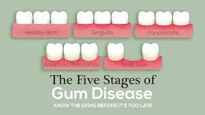 How to reverse gum disease fast. The Five Stages Of Gum Disease The Mckenzie Center Implants Periodontics