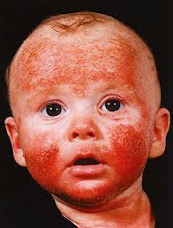 Atopic dermatitis