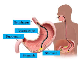 This usually means no food or drink after midnight. Gastroscopy In Singapore Andrea Digestive Clinic Com