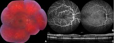 Image result for Hyperviscosity Syndrome