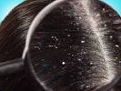 How To Tell If You Have Lice Or Dandruff
