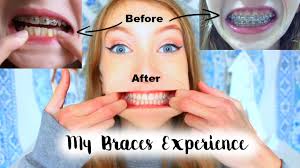The idea of volunteering for a fixed brace may horrify those of us who wore them in our teens but a growing number of british adults are choosing to do so. My Braces Experience Train Tracks Retainers Youtube