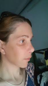 Transgender SRS surgery help