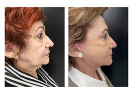 Lifting Facial (Ritidoplastia)