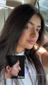 Antes y después de su cirugía de nariz ❤️ #rhinoplasty #fyp #followme  #colombia #medellin #miami