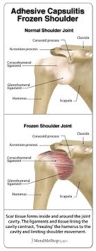 Pin By Lisa Hamilton On Anatomy Pt Library Frozen Shoulder Treatment Frozen Shoulder Physical Therapy