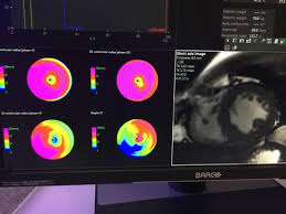 Machine Learning Could Offer Faster More Precise Cardiac