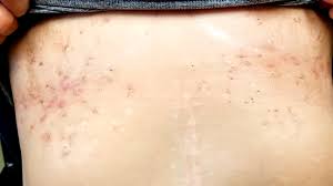Lubricating the skin around this area. Hidradenitis Suppurativa Symptoms Treatment Diet Pictures More