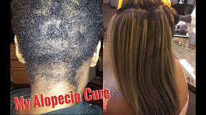 My hair is nonetheless growing properly. How I Cured My Hair Loss Alopecia Areata Iamlindaelaine Youtube