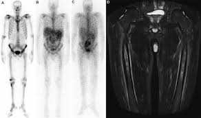 Image result for periostitis