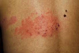 Image result for shingles