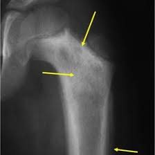 Image result for Ewing Sarcoma