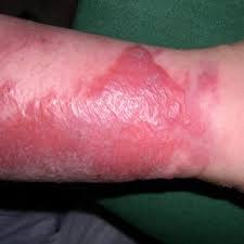 Image result for erysipel photos)