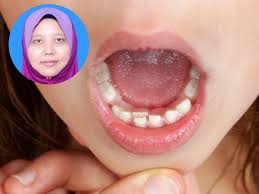 Salah satu gangguan gusi yang biasanya menyerang banyak orang adalah gusi bengkak. Gigi Kekal Sudah Tumbuh Di Belakang Perlukah Gigi Susu Dicabut Ini Kata Doktor Gigi Pa Ma