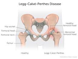 Image result for Perthes Test