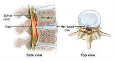 Image result for what is the treatment for compression thecal sac