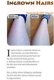 Ingrown leg hair hair irritation infected hair follicle ingown hair tweezer leg tweezers leg laser hair removal treatment laser hair removal armpit science acne laser hair removal vector. Ingrown Hair On Legs Ingrown Leg Hair Ingrown Hair Hair And Nails