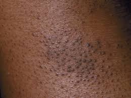 Image result for Keratosis pilaris