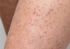 Image result for allergy rash on the legs