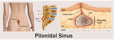 The main concern is infection, which can result in a painful abscess. Pilonidal Sinus Nasur Nirmal Hospital