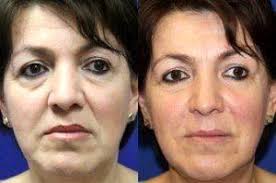 Check spelling or type a new query. Restylane Or Juvederm For Marionette Lines Facial Injections Info Prices Photos Reviews Q A