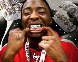 Custom Grillz: Missing Tooth Add-on