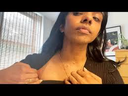 Stranger Films Woman With Skin Condition